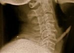 3_implant